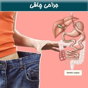 جراحی چاقی