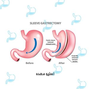 اسلیو معده