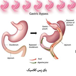 بای پس کلاسیک