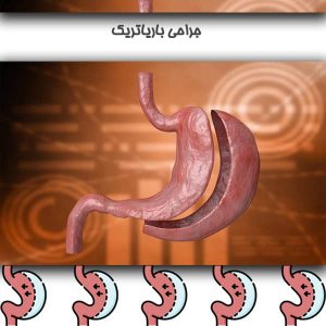 جراحی باریاتریک
