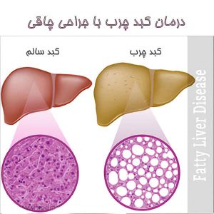 درمان کبد چرب با جراحی چاقی