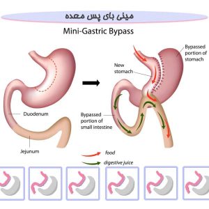 مینی بای پس معده