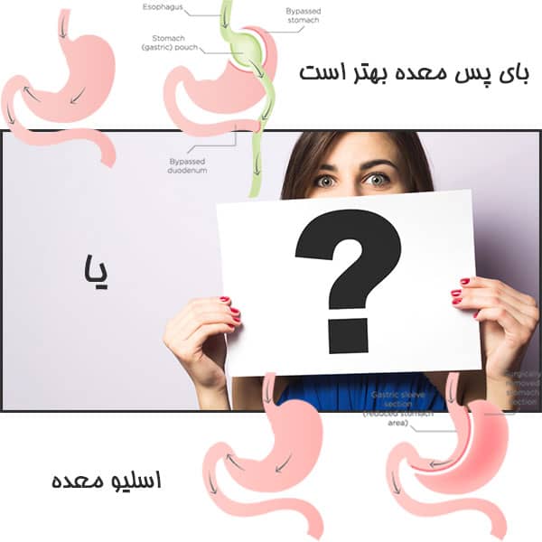 بای پس معده بهتر است یا اسلیو معده