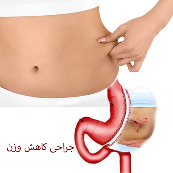 جراحی کاهش وزن