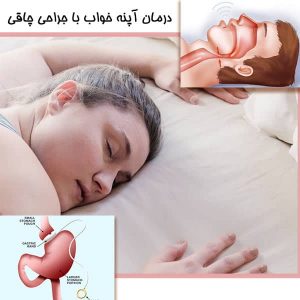 درمان آپنه خواب با جراحی چاقی