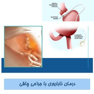 درمان ناباروری با جراحی چاقی