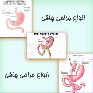 انواع جراحی چاقی