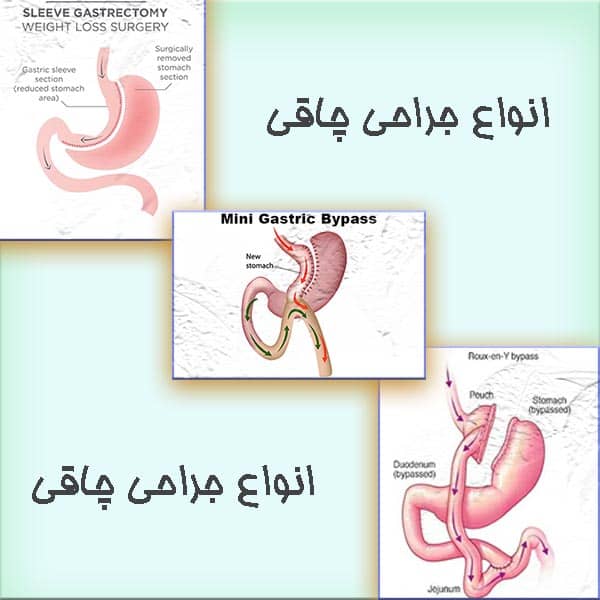 انواع جراحی چاقی