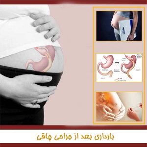 بارداری بعد از جراحی چاقی