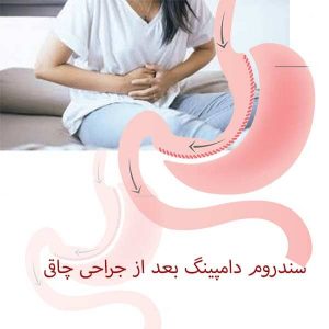 سندروم دامپینگ بعد از جراحی چاقی