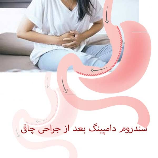 سندروم دامپینگ بعد از جراحی چاقی