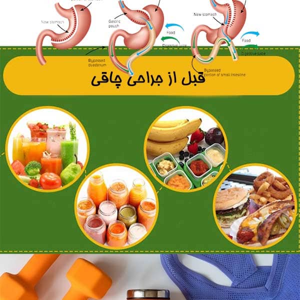 قبل از جراحی چاقی