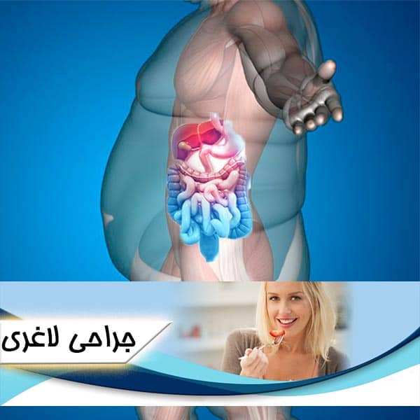 جراحی لاغری 