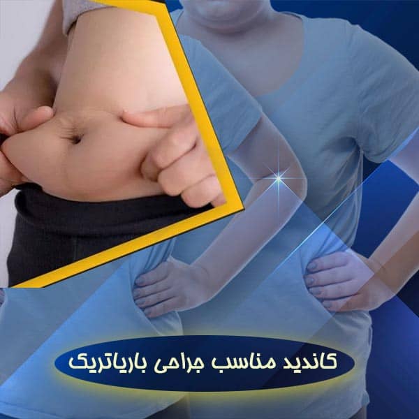 کاندید مناسب جراحی باریاتریک