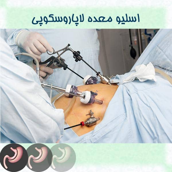 اسلیو معده لاپاروسکوپی