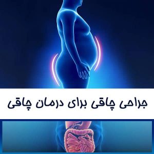 جراحی چاقی برای درمان چاقی