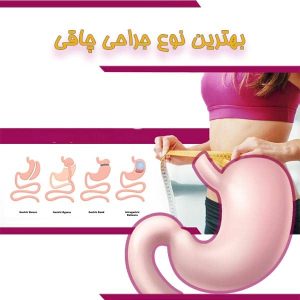 بهترین نوع جراحی چاقی