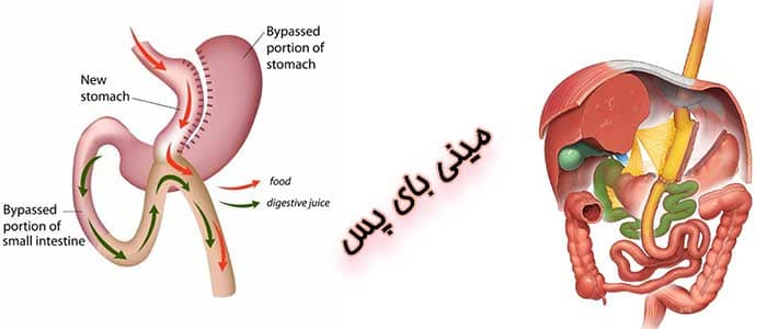 تفاوت بای پس معده و مینی بای پس 3