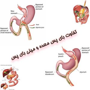 تفاوت بای پس معده و مینی بای پس