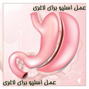 عمل اسلیو برای لاغری