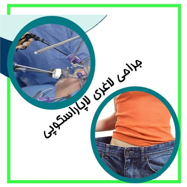 جراحی لاغری لاپاراسکوپی