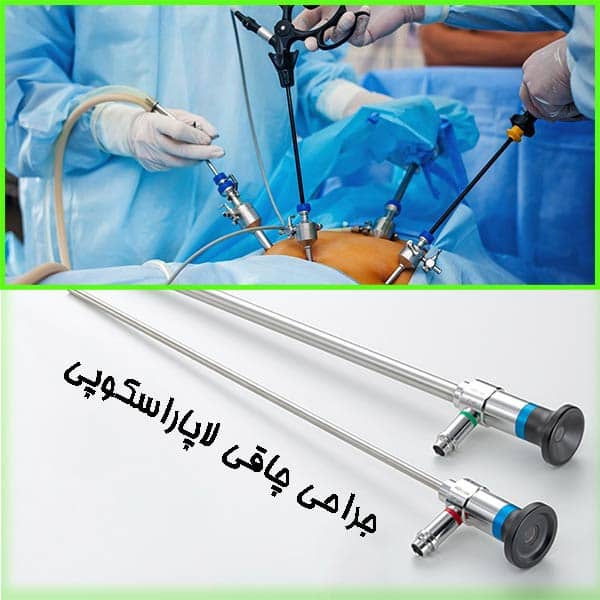 جراحی چاقی لاپاراسکوپی