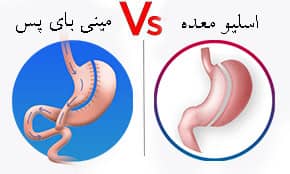 کاندید مناسب مینی بای پس 3