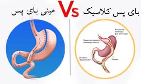 کاندید مناسب مینی بای پس 4