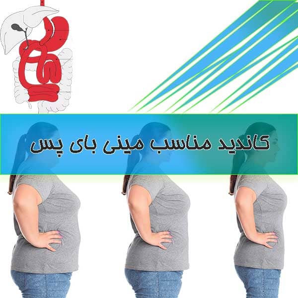 کاندید مناسب مینی بای پس