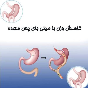 کاهش وزن با مینی بای پس معده
