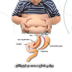 جراحی اسلیو معده در نوجوانان