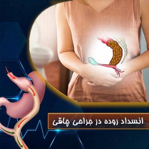 انسداد روده در جراحی چاقی