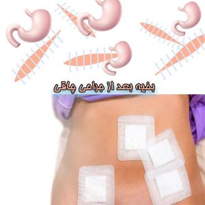 بخیه بعد از جراحی چاقی