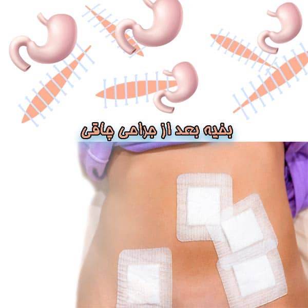 بخیه بعد از جراحی چاقی