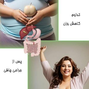تداوم کاهش وزن پس از جراحی چاقی