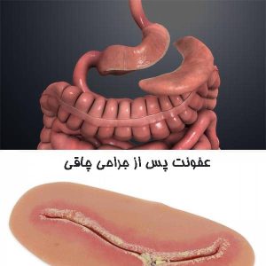 عفونت پس از جراحی چاقی
