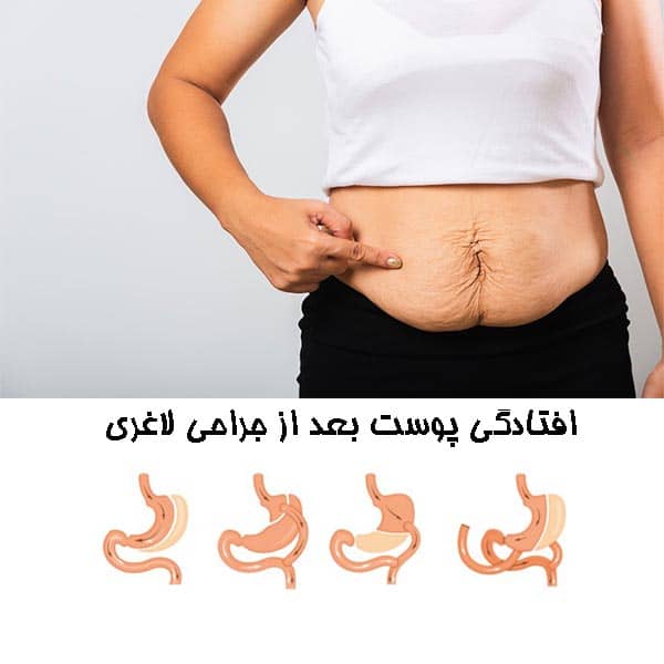 افتادگی پوست بعد از جراحی لاغری