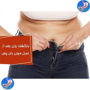 بازگشت وزن بعد از عمل مینی بای پس