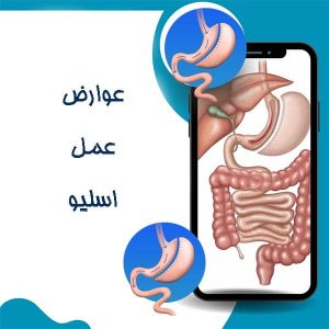 عوارض عمل اسلیو