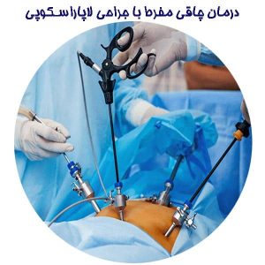 درمان چاقی مفرط با جراحی لاپاراسکوپی
