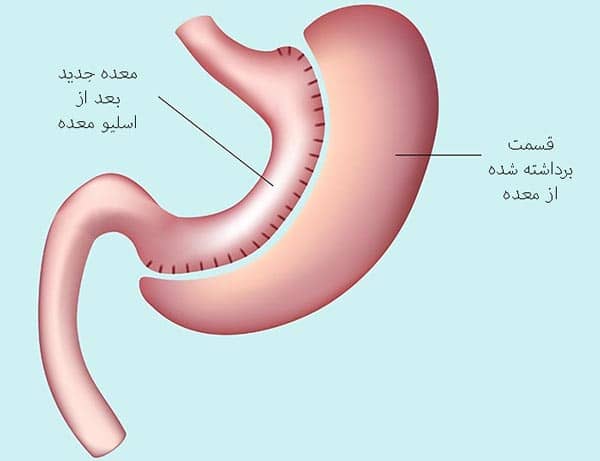 مراحل قبل از اسلیو معده 1