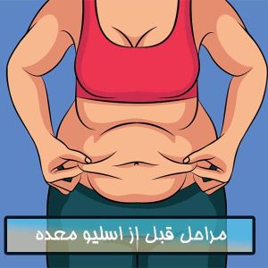 مراحل قبل از اسلیو معده