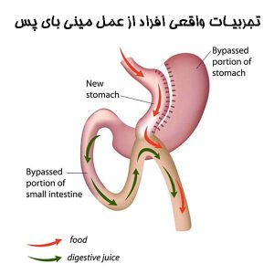 تجربیات واقعی افراد از عمل مینی بای پس