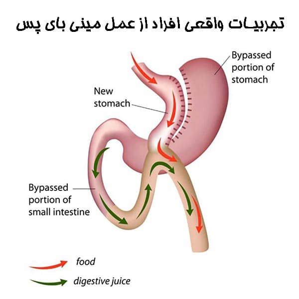 تجربیات واقعی افراد از عمل مینی بای پس