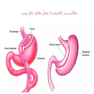 مکانیسم لاغری با عمل های بای پس