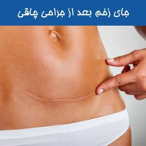 جای زخم بعد از جراحی چاقی