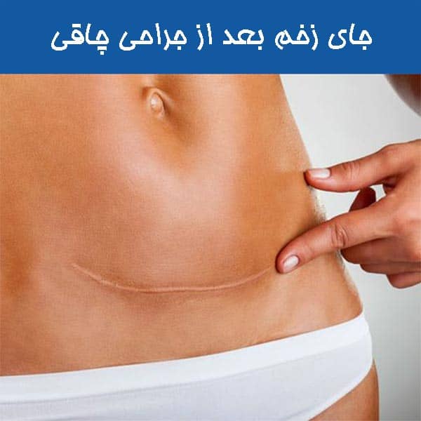 جای زخم بعد از جراحی چاقی