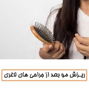ریزش مو بعد از جراحی های لاغری