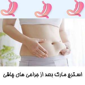 استرچ مارک بعد از جراحی های چاقی