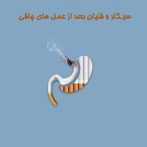 سیگار و قلیان بعد از عمل های چاقی